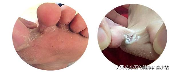 足癣瘙痒用什么药膏,脚丫溃烂水泡型足癣最怕的克星