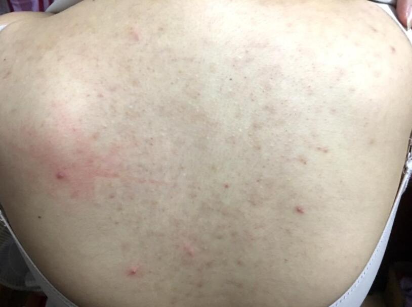 后背干燥长痘痘的原因和解决方法,背后长痘痘的原因和解决方法女生