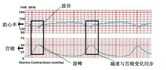 怎么能顺利快速通过胎心监护,怎么使胎心监护快速过关