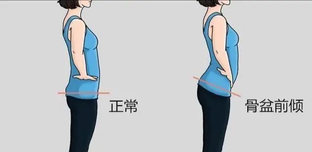 膝超伸腿粗运动可以改善吗,大粗腿膝超伸矫正方法图解