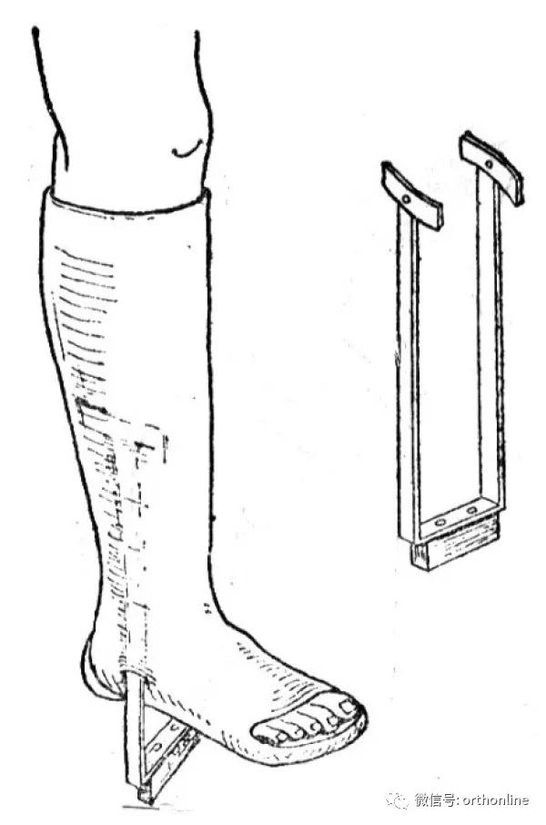 石膏固定术的科普视频,石膏固定术的正确方法