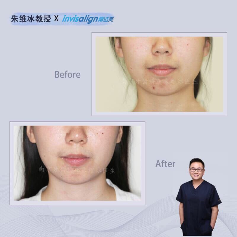 隐适美牙齿拥挤矫正真实案例,南京朱维冰