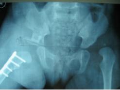 儿童发育性髋脱位表现,发育性髋关节脱位治疗4-7岁