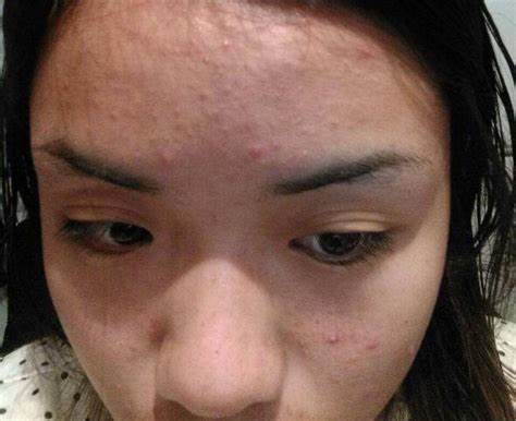 夏天怎么祛痘最有效,夏天长痘痘用什么护肤品