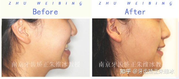 南京透明式牙齿矫正器地包天,18岁功能性地包天能改善面型吗