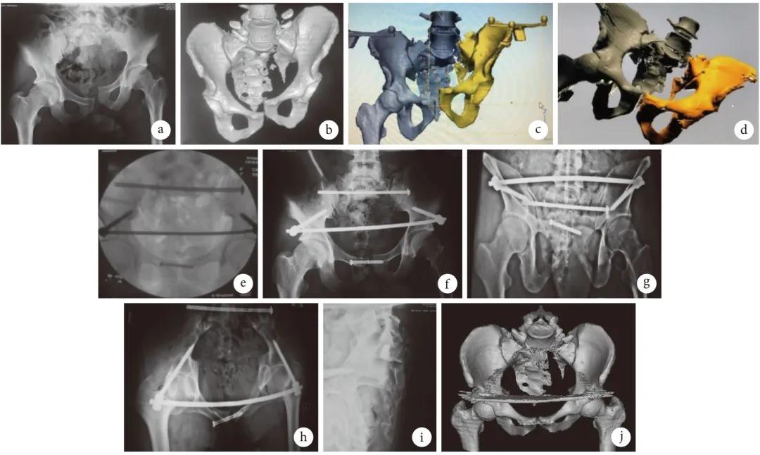 骨盆骨折复位只能凭经验＋透视？这项技术可能会颠覆你的认知