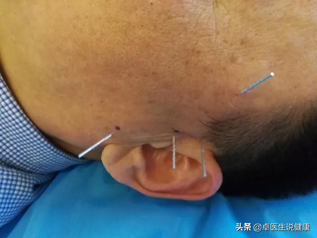 中医眼科飞蚊症验方大全,中医治疗飞蚊症穴位