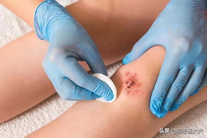 小孩伤口怎么不留疤,伤口怎么不留疤快速恢复