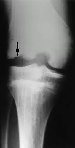 神经性骨关节病,神经性关节炎症状图片