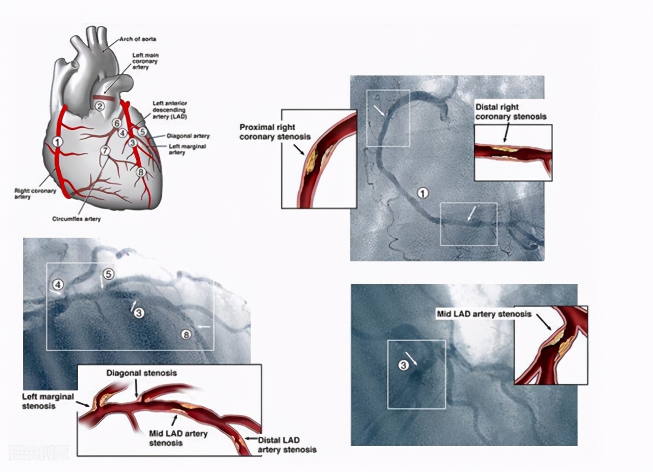 冠状动脉钙化和粥样硬化哪个严重,冠状动脉钙化和硬化哪个严重