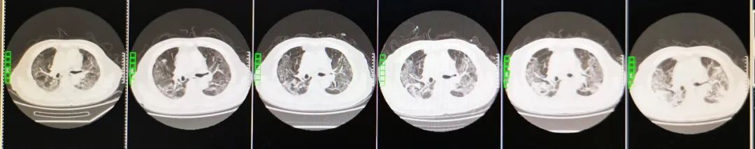 核酸检测阴性抗体阳性怎么回事,一确诊病例17次核酸检测阴性