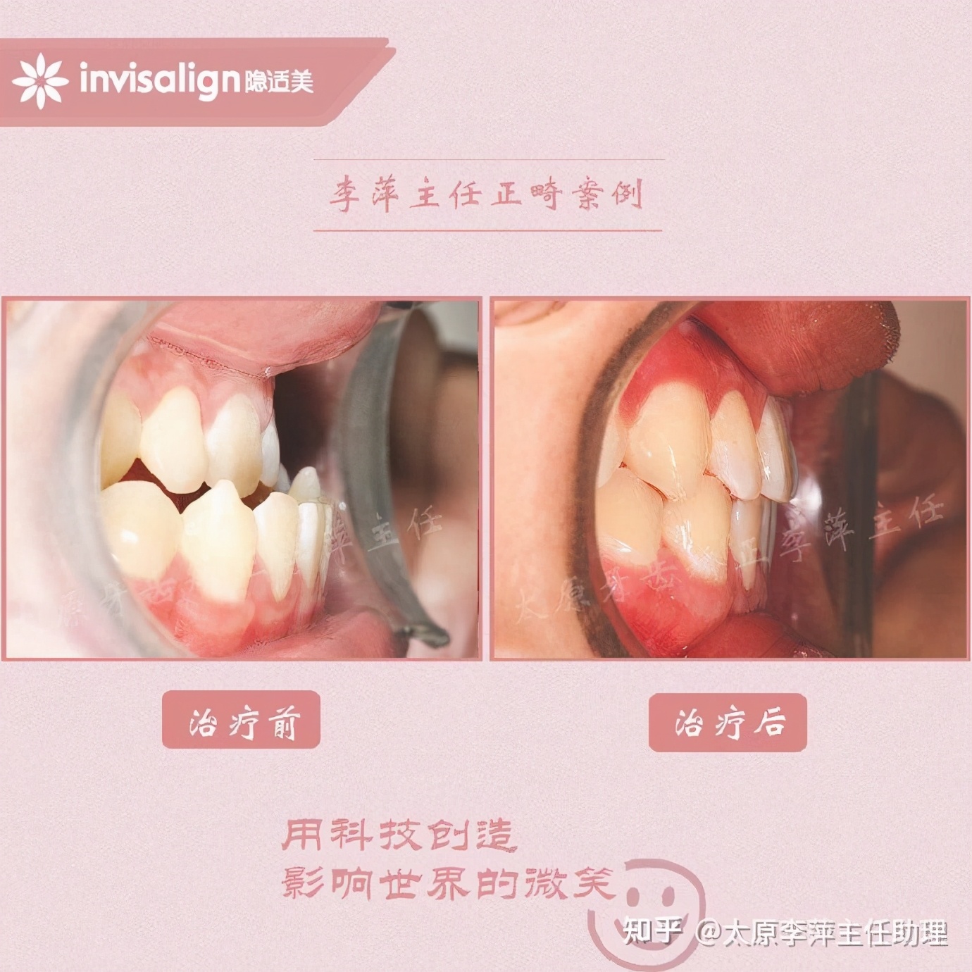 太原矫正牙齿需要做正颌吗,太原牙齿二次矫正