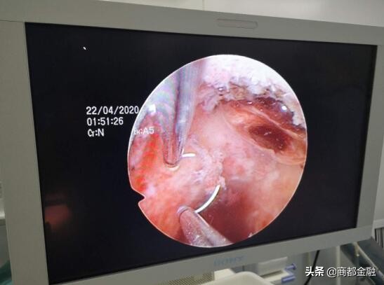 无刀口、无介入，中西医结合，简单几步轻松治疗胎盘植入