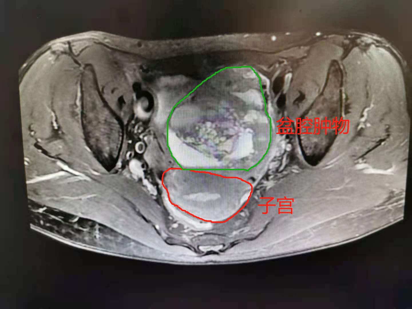 南大二附院妇产科完成一例经脐单孔腹腔镜卵巢恶性性索间质肿瘤全面分期手术