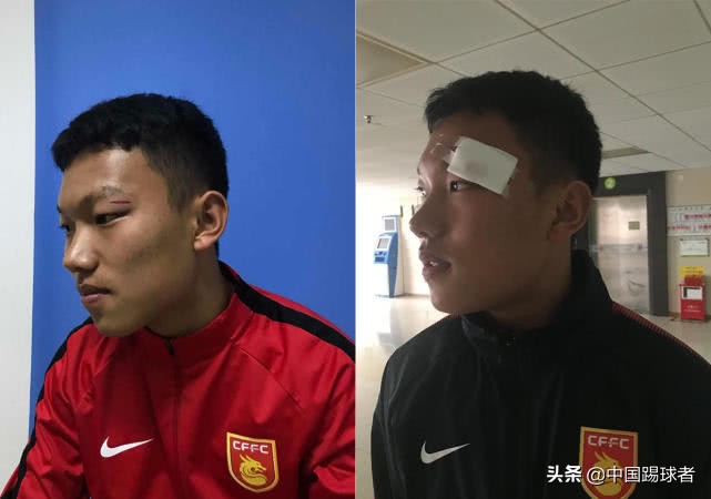 恒大杯越南球员就*力暴**伤人登门致歉河北小将眼睑被打开缝了六针
