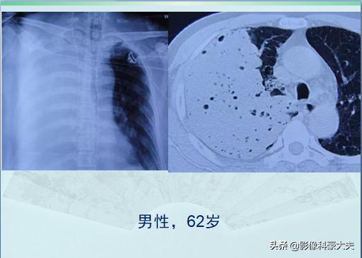肺炎比肺结核严重吗,新冠肺炎对癌症有影响吗