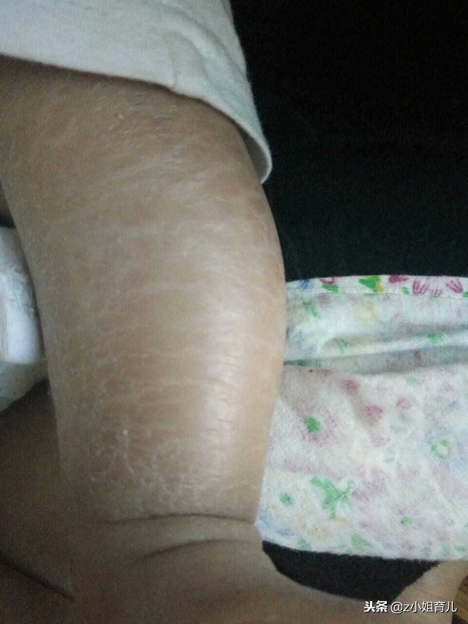 冬天宝宝皮肤干燥有什么办法,冬天宝宝皮肤干燥起皮怎么办