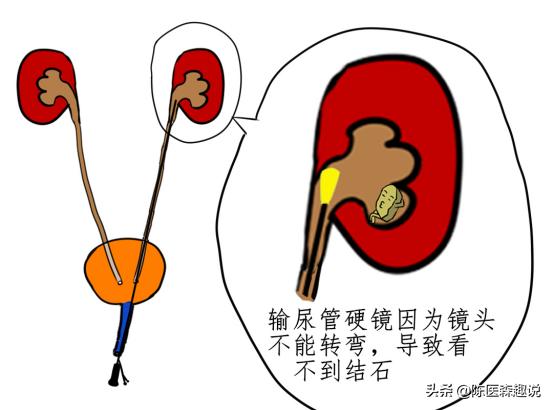 发现肾结石怎样治疗更好,发现肾结石怎么办