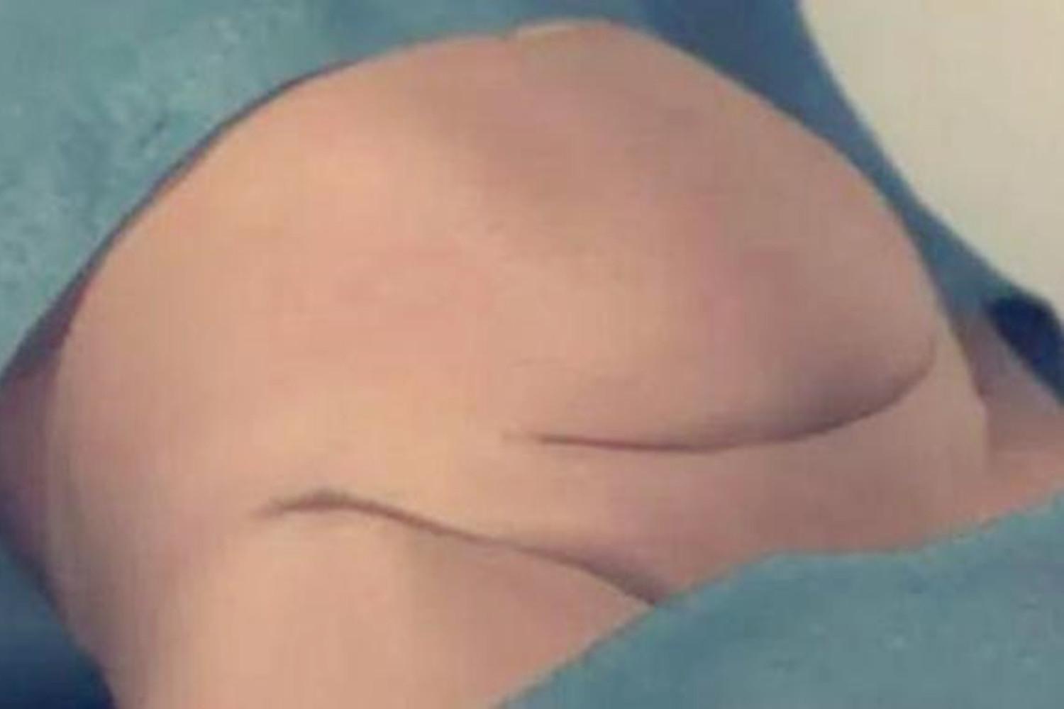 剖腹产只挨一刀,剖腹产都是挨一刀吗