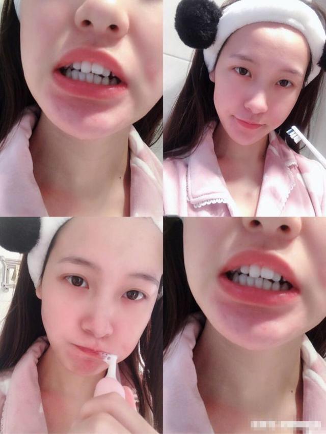 满口全瓷牙的明星李沁,李沁矫正牙齿前的照片
