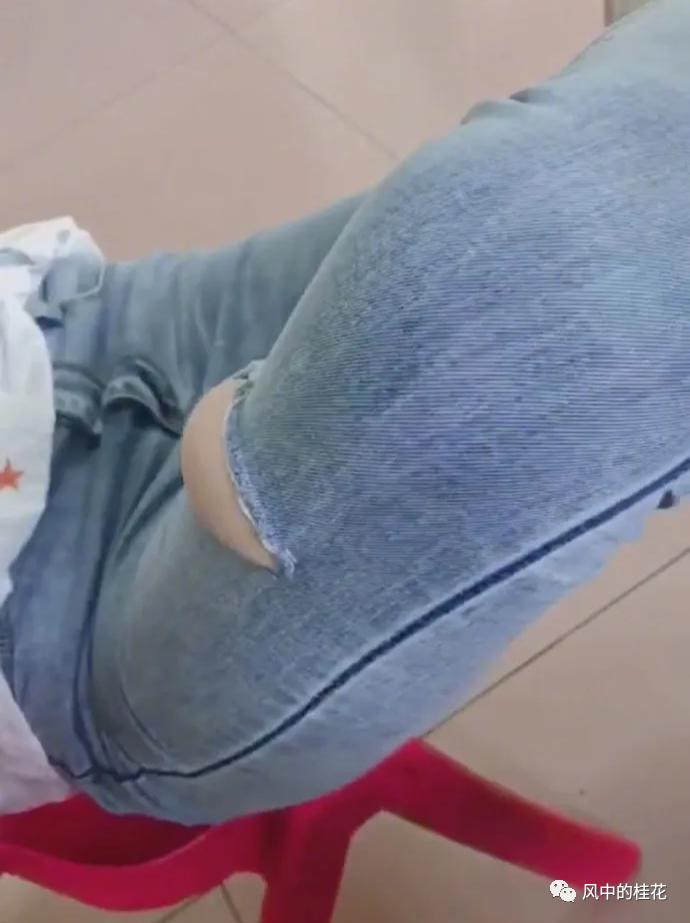 溜冰摔倒了膝盖不能弯曲,溜冰摔倒膝盖肿了怎么办