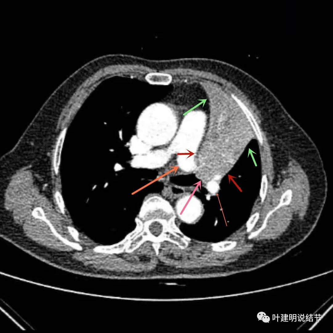 高龄肺癌靶向治疗效果,高龄老人肺癌早期适合放疗吗