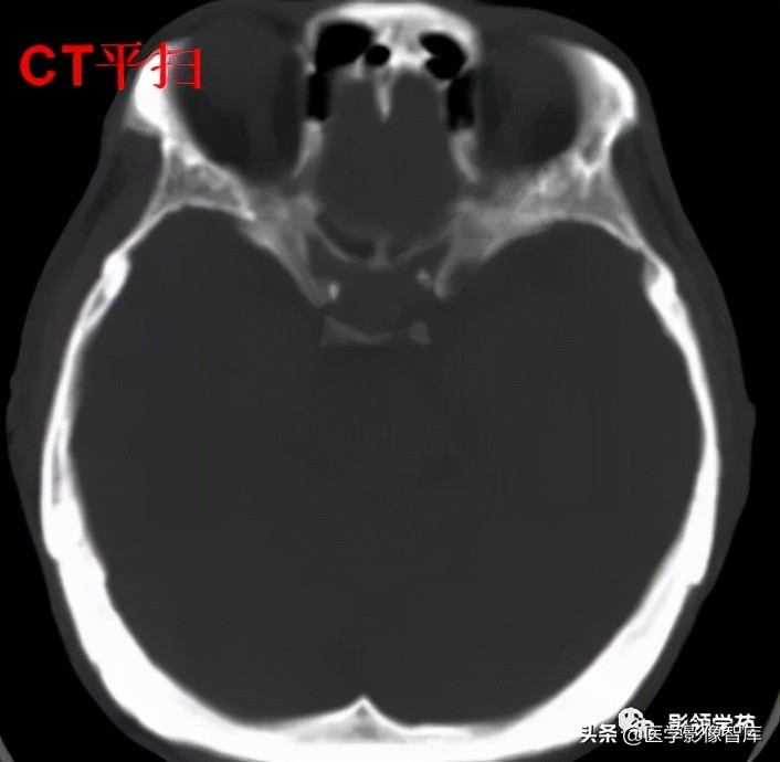 鞍区肿瘤做什么检查得出来,鞍区肿瘤的影像学鉴别
