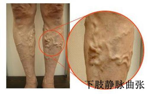 痔疮手术后预防水肿怎么按摩,痔疮是需要怎样治疗