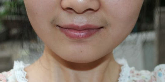 女性唇毛严重该怎么治疗,女性唇毛一边多一边少什么原因