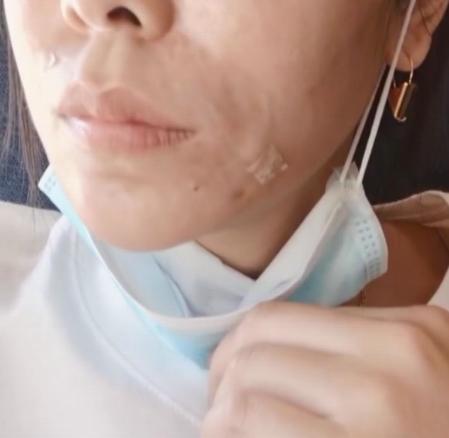 雅美整形花5万多做的面部填充术，结果还得分三次取出，太遭罪了！卫生监督所已展开调查