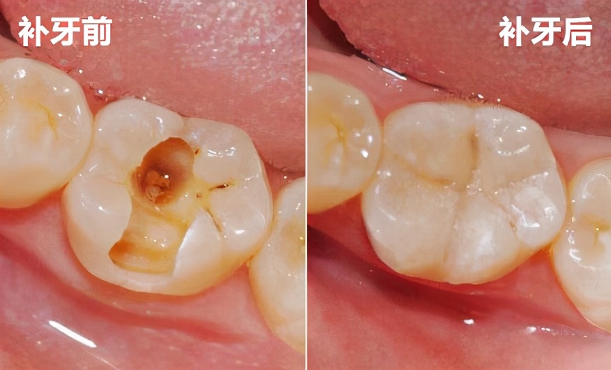 补牙是怎么补的揭秘补牙全过程,补牙是不是越补牙洞越大