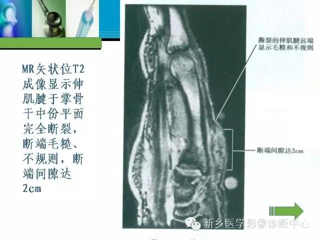 单只手指磁共振,手指用磁共振能做出来结果吗