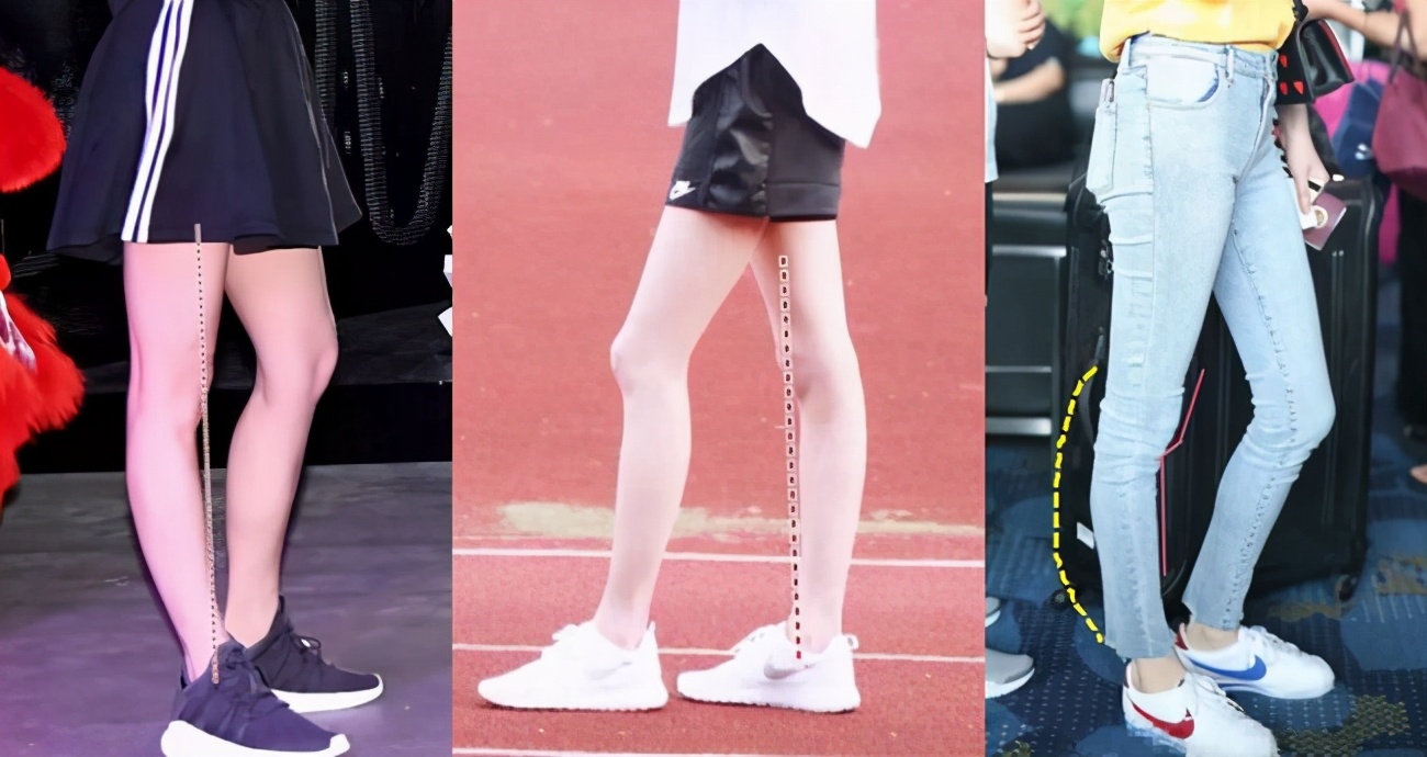 小腿外翻膝超伸如何改善,单侧膝超伸导致腿短一点