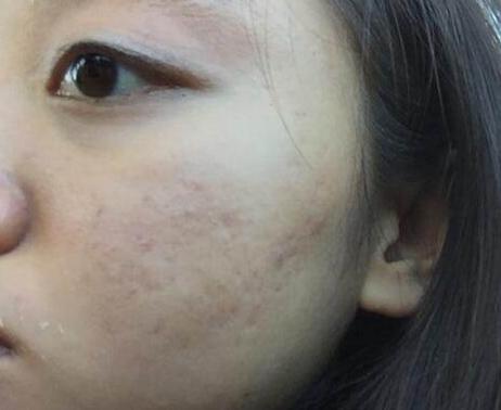 教你几招祛痘印的最快方法,怎么祛痘印最简单实用的方法