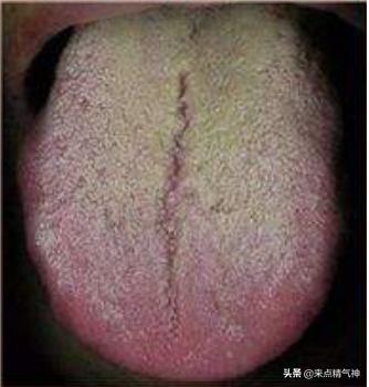 胃痛上火吃什么最快降火,胃痛舌苔红齿痕是什么原因