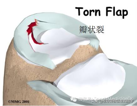 半月板损伤通常是单膝还是双膝,你知道半月板是什么吗