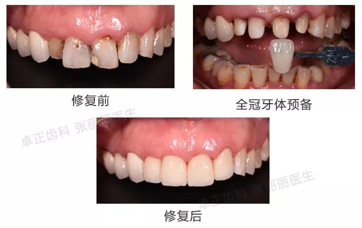 牙齿缺损全瓷冠修复多少钱,牙齿楔状缺损修复大概多少钱