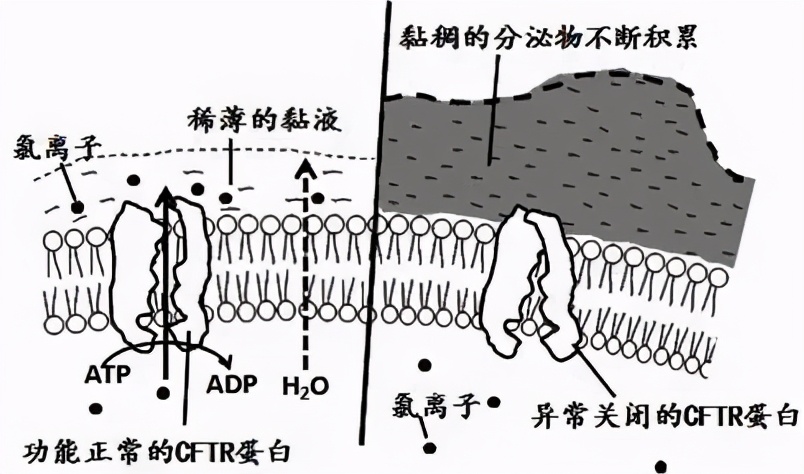 支气管扩张会导致杵状指吗,支气管扩张有杵状指吗