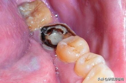没形成牙洞前蛀牙可以自愈吗,严重蛀牙有个大洞怎么办