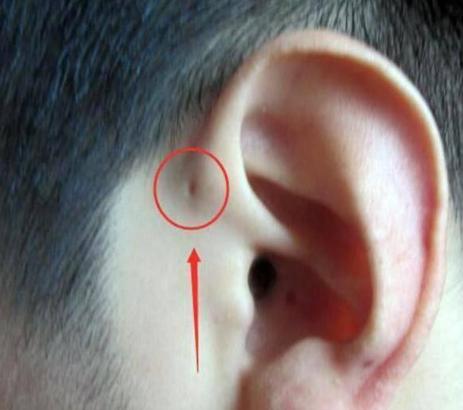 新生儿耳朵有个小孔正常吗,为什么新生儿宝宝耳朵有洞