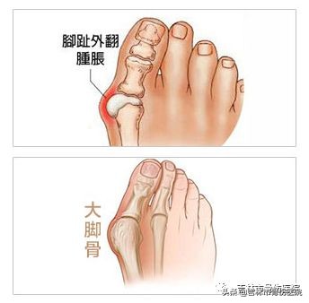 大脚骨会带来哪些危害,割大脚骨的危害