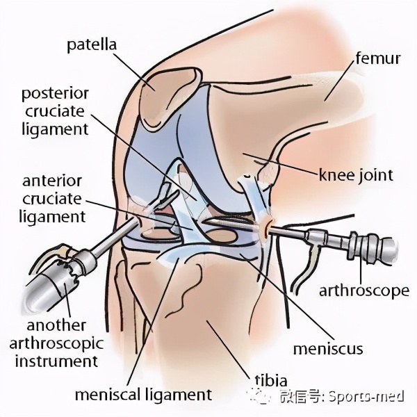 一种不一样的前交叉韧带