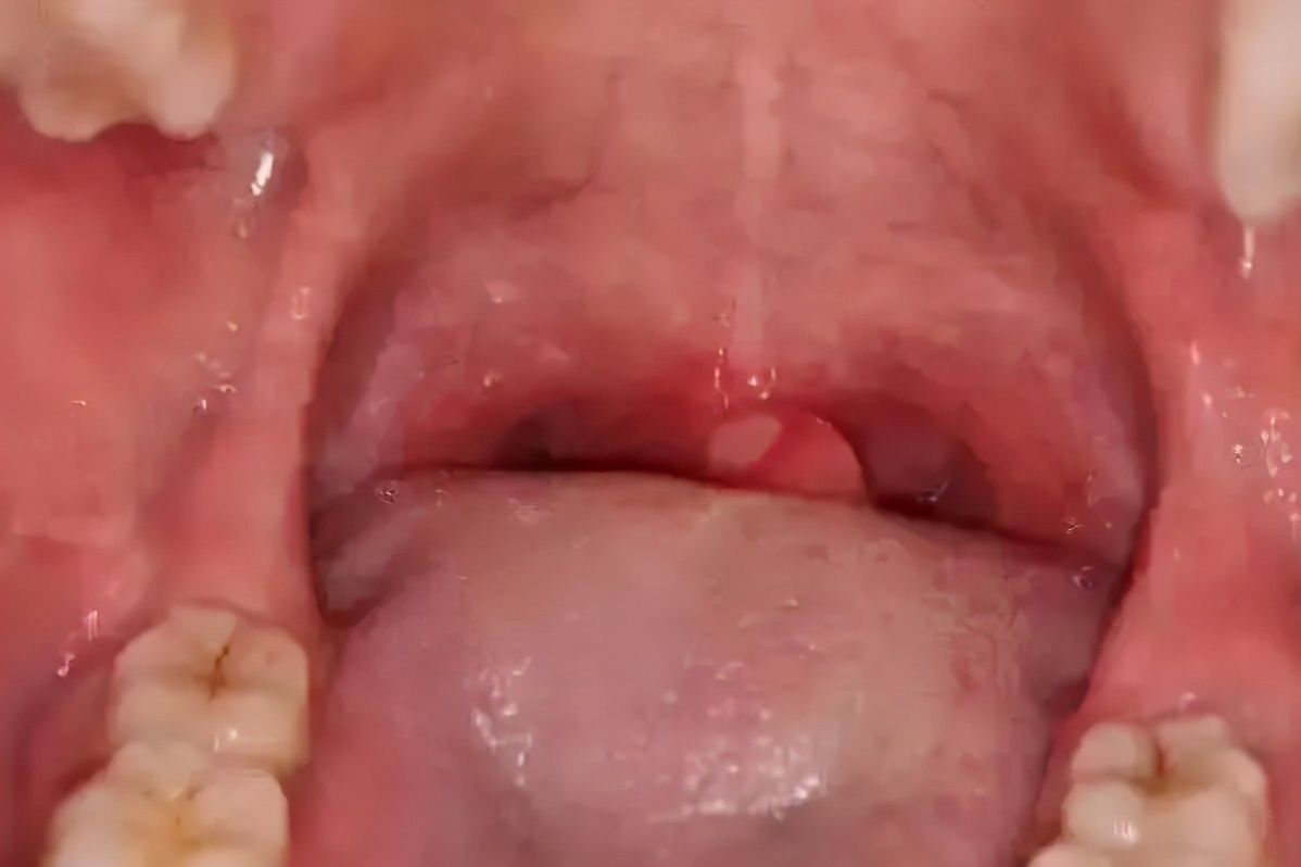 深圳男子口腔溃疡8年，还蔓延全身！竟是这种怪病！