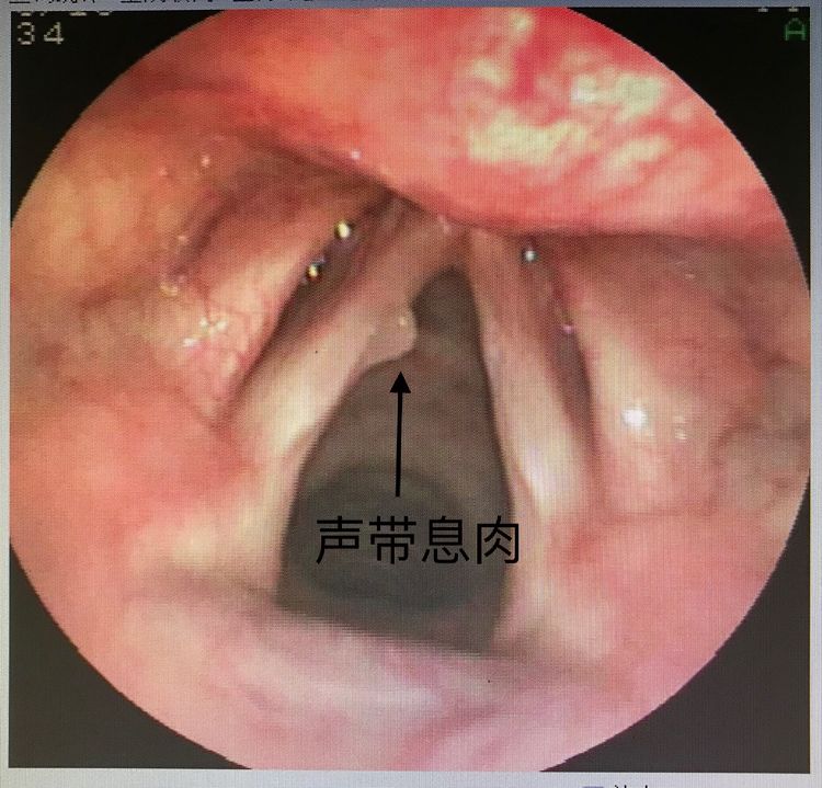 声带息肉对身体有什么危害和影响,声带息肉的危害