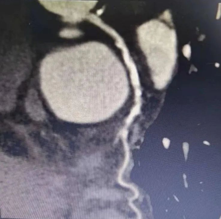 北京积水潭医院心内科成功开展医疗新技术！准分子激光冠脉消蚀术与冠脉旋磨术治疗冠脉钙化病变