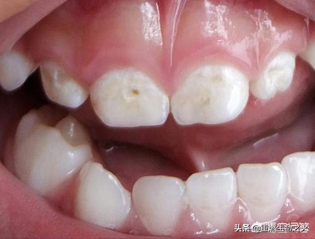 孩子乳牙坏了你会给孩子补牙吗,孩子乳牙烂了补牙要不要打麻药