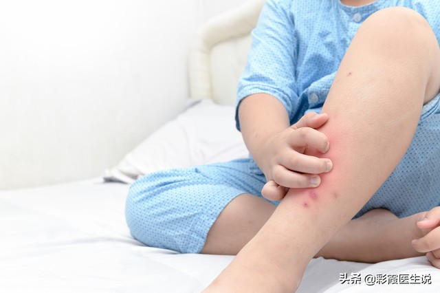 如何缓解蚊虫叮咬的痒,肥皂水擦拭可以缓解蚊虫叮咬吗