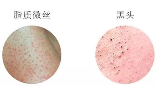 清洁皮肤去黑头缩毛孔用什么产品,男士去黑头缩毛孔用什么洗面奶