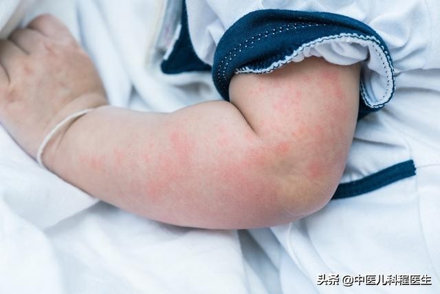 宝宝湿疹怎么护理和预防,宝宝湿疹如何正确护理