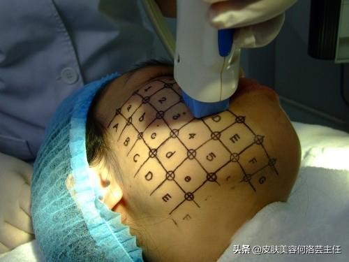 热玛吉有必要做么,热玛吉适用于什么人群